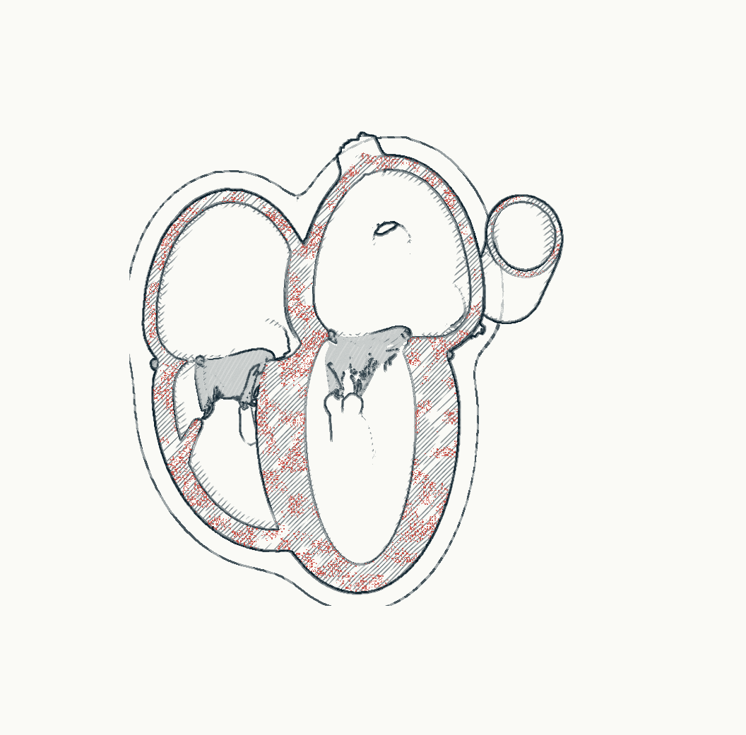 Hand-drawn four-chamber cut of a heart with advanced cardiac amyloidosis — thick walls, a small cavity, enlarged atria, with amyloid deposits marked in red.