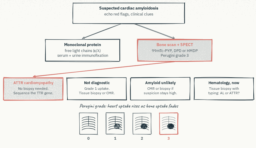 Non-invasive work-up flowchart: from suspected cardiac amyloidosis, a monoclonal-protein screen and bone scintigraphy with SPECT resolve into ATTR cardiomyopathy (strong uptake, no monoclonal protein — no biopsy needed), hematology referral and biopsy (monoclonal protein present), or further imaging when not diagnostic.