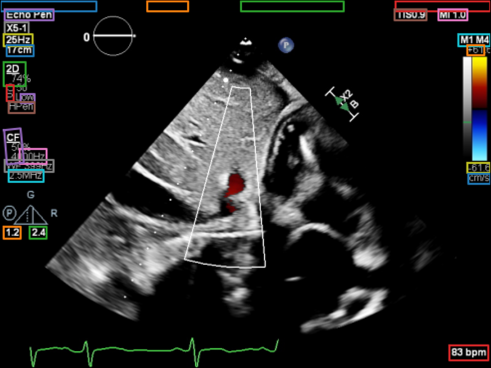 Burn-in annotation removal example 1