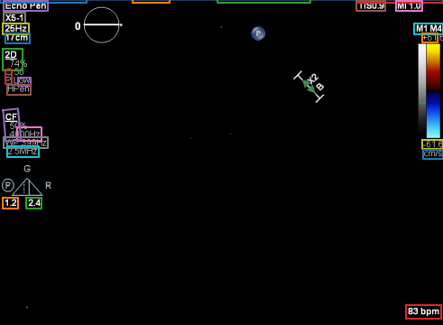 Burn-in annotation removal example 2