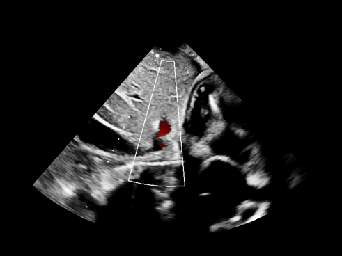 Burn-in annotation removal example 3