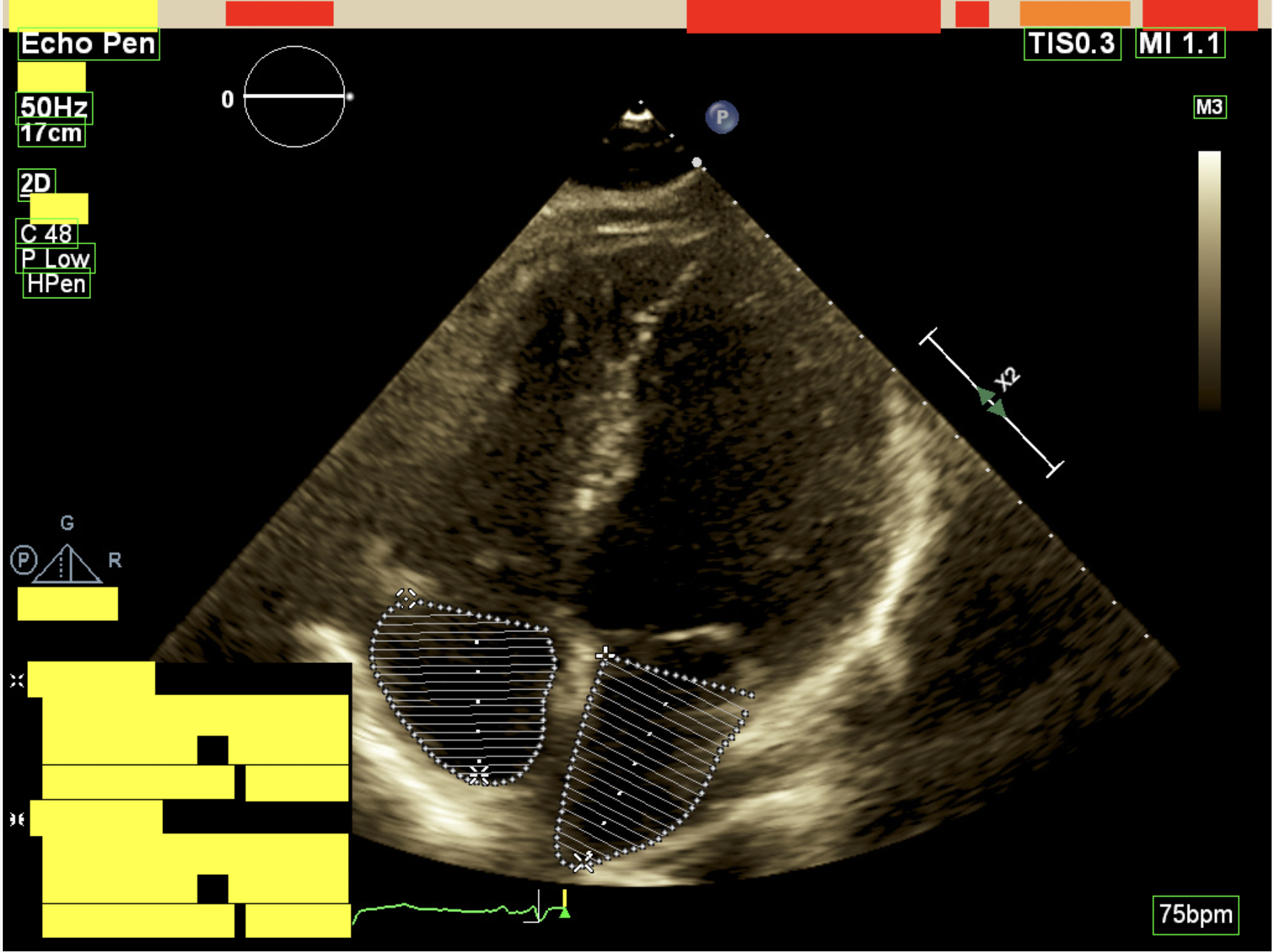 Deidentified echocardiography study example
